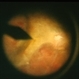 Fibrovascular Proliferation